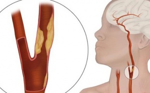 Xơ vữa động mạch cảnh: Nguyên nhân và dấu hiệu nhận biết thế nào?