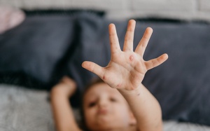 Thủy đậu và những biến chứng nguy hiểm với sức khỏe