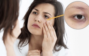 Nguyên nhân và cách trị quầng thâm mắt tại nhà