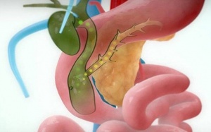 Khi nào cần mở ống mật chủ lấy sỏi, cách thực hiện thế nào?