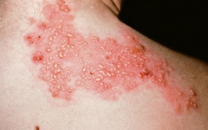  Tất tần tật về thuốc trị zona bạn cần phải biết