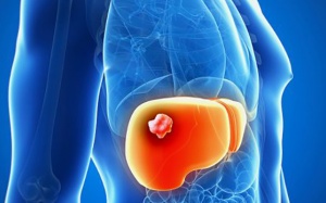 Những điều cần biết về ung thư gan nguyên phát