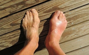 Dấu hiệu bệnh gout ở chân và cách kiểm soát bệnh từ thảo dược