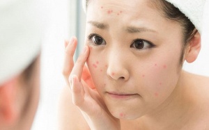 Làm thế nào để trị mụn tại nhà an toàn?