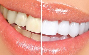 “Điểm mặt” 6 thói quen khiến răng bạn ố vàng