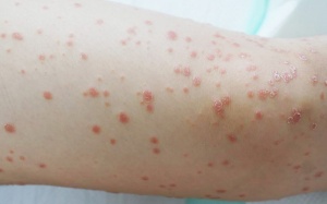 Biện pháp giúp cải thiện bệnh vảy nến thể giọt tại nhà hiệu quả