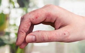 Cách chăm sóc da khi mắc bệnh chàm ở bàn tay