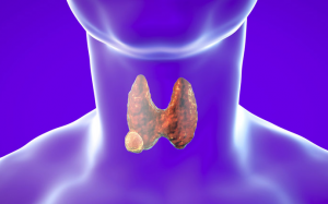 Nhân tuyến giáp: Dấu hiệu và phương pháp điều trị bệnh hiệu quả