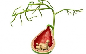 Review sản phẩm hỗ trợ tốt từ bài thuốc Đông y trị sỏi mật