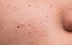Mụn đầu đen: Những điều bạn nên biết!