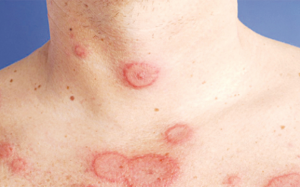 Biến chứng của bệnh lupus ban đỏ và giải pháp từ thảo dược