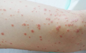 Vảy nến thể giọt là bệnh gì, có chữa được không?