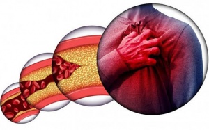 Cách kiểm soát bệnh máu nhiễm mỡ hiện nay