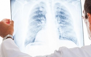 Người đã mắc COVID-19 có nên đi chụp phổi?