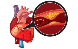 Thiếu máu cơ tim là gì, bệnh có những dạng nào?