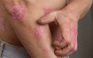 Những yếu tố làm bùng phát bệnh vảy nến và giải pháp cải thiện