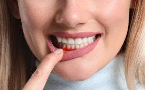 Làm thế nào để ngăn ngừa viêm nha chu tái phát?