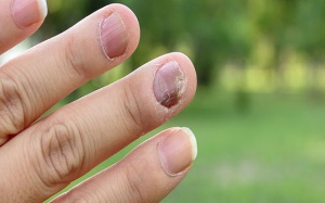 Vì sao móng tay tôi đang bắt đầu rụng?