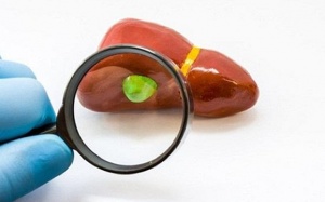 Sỏi mật 8mm có nguy hiểm không, nên điều trị thế nào?