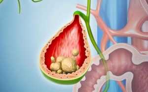 Sỏi túi mật 6mm có nghiêm trọng không, xử trí thế nào?