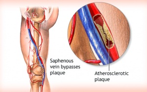 Người bị xơ vữa động mạch chi dưới tập luyện như thế nào, nên ăn gì?