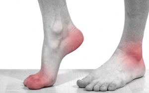 Tại sao trời lạnh cơn gout cấp lại “phát tác”?