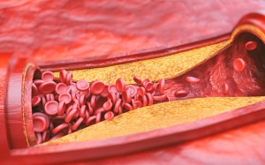 Giải pháp từ thiên nhiên cho xơ vữa động mạch