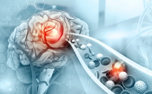 Tại sao xơ vữa động mạch có thể gây đau đầu, tai biến, đột quỵ?