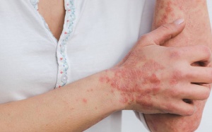 Cách chăm sóc da khi bị vảy nến thể mảng