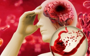 Xơ vữa động mạch ở người tăng huyết áp, mỡ máu cao nguy hiểm thế nào?