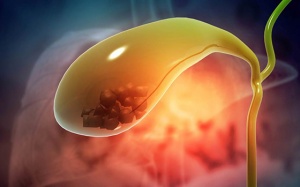 Sỏi túi mật 10mm và men gan cao nên điều trị thế nào?