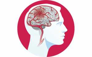 Tại sao đột quỵ não lại nguy hiểm cho người mắc? 