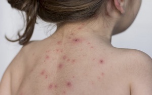 Bị thủy đậu nên kiêng gì giúp mau lành vết thương, ngăn ngừa sẹo thâm?