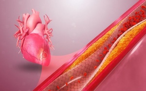 Hẹp mạch vành mức độ nào thì nên đặt stent?