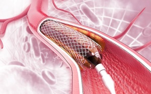 Những ai không được đặt stent để điều trị bệnh mạch vành?