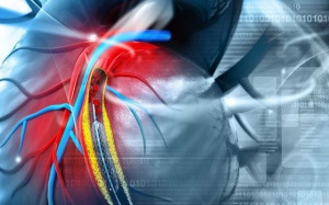 Các phương pháp chụp mạch vành chẩn đoán thiếu máu cơ tim và chi phí