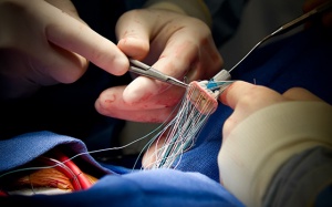 Phẫu thuật hẹp, hở van tim ở Việt Nam có tốt không, chi phí thế nào?