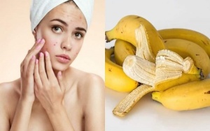 Bí quyết sử dụng vỏ chuối trị mụn dễ làm và hiệu quả