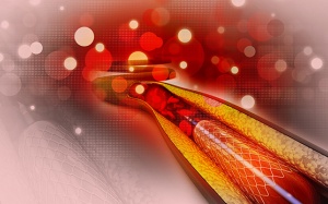 Người bệnh cần được chăm sóc thế nào sau khi đặt stent?