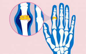 Làm thế nào để cải thiện tình trạng gout ở bàn tay?