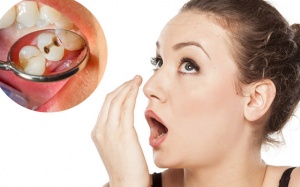 Sâu răng là “thủ phạm” gây hôi miệng?