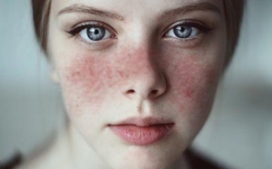 Dấu hiệu lupus ban đỏ và giải pháp cải thiện từ thảo dược