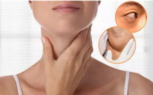 Basedow - Nguyên nhân và cách điều trị hiệu quả