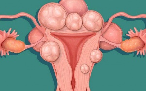 U xơ tử cung: Biến chứng và cách cải thiện bệnh hiệu quả