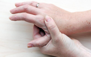 Hậu COVID-19, người bị lupus ban đỏ cần lưu ý gì?