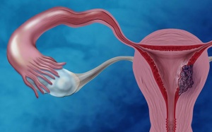 Thừa cân làm tăng gấp đôi nguy cơ ung thư nội mạc tử cung