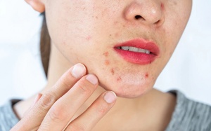 Vị trí mụn trên khuôn mặt tiết lộ những vấn đề gì?