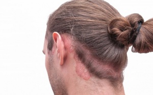 Da đầu ngứa, bong tróc do vảy nến, làm sao để cải thiện?