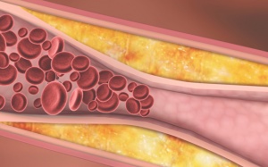Máu nhiễm mỡ gây nên những biến chứng nguy hiểm nào?
