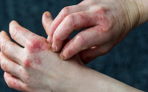 Lưu ý khi chăm sóc da trong mùa hè cho người bị viêm da cơ địa